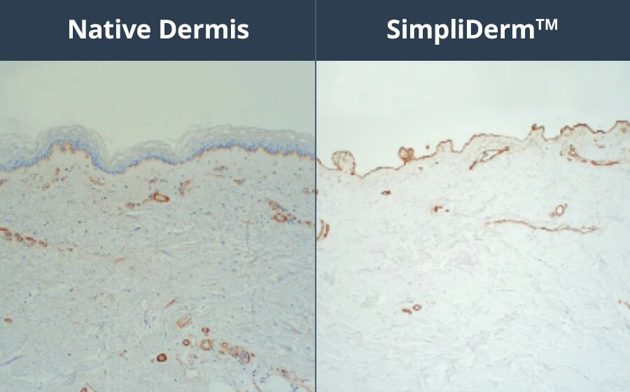 a comparison between the native dermis and SimpliDerm