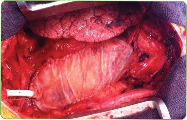 Vascularized native pericardium shown in the remodeled tissue